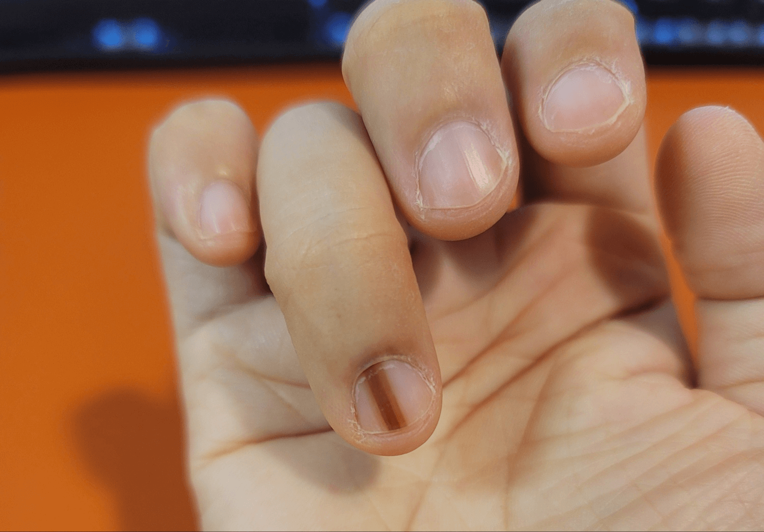 손톱 세로줄 병원 진료 후기, 손톱 흑색종 의심 증상 7